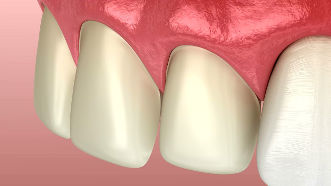 Dentalne ljuskice