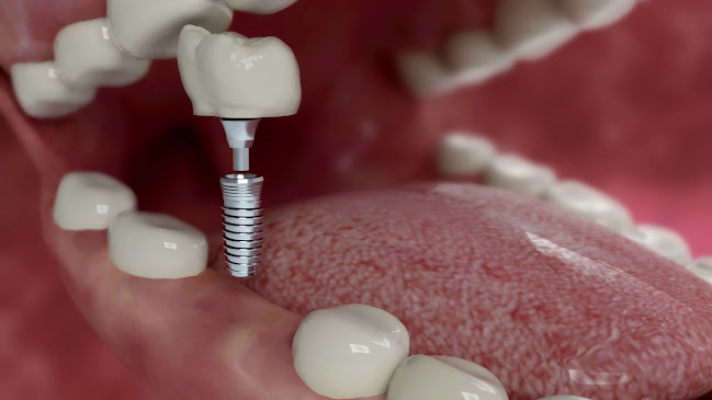 Ilustracija dentalnog implantata